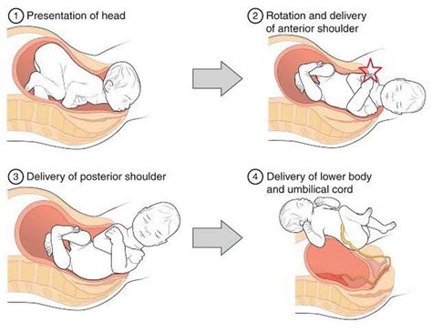 alarm shoulder dystocia|Shoulder Dystocia .